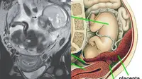 Ibu Hamil Ini Mengandung Janin di Usus  (Sumber: NEJM dan Wikimedia Commons)