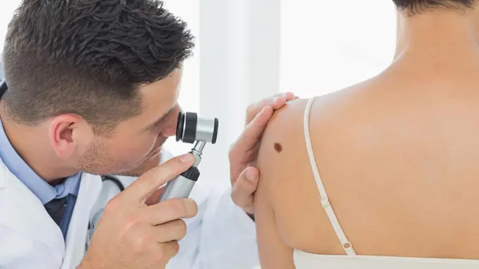 Inilah Tanda Tahi Lalat yang Berbahaya