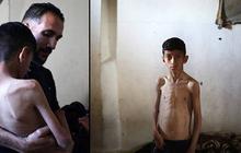 Potret Miris Anak-Anak Palestina di Gaza 'Tinggal Tulang' Akibat Kelaparan yang Diciptakan Israel