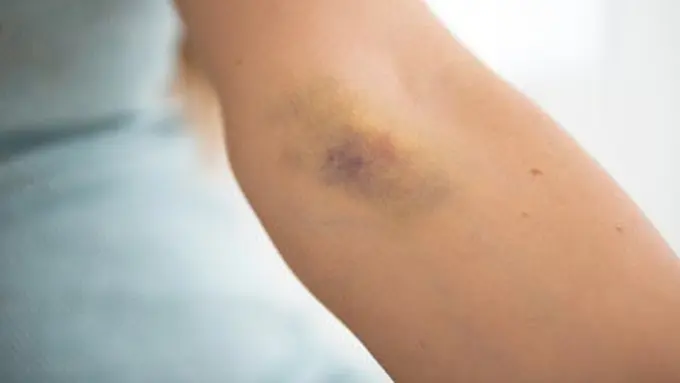 Cara Mengatasi Lebam yang Mudah Muncul