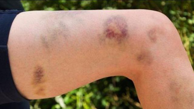 Ilustrasi luka memar (Foto: RSUD Buleleng)