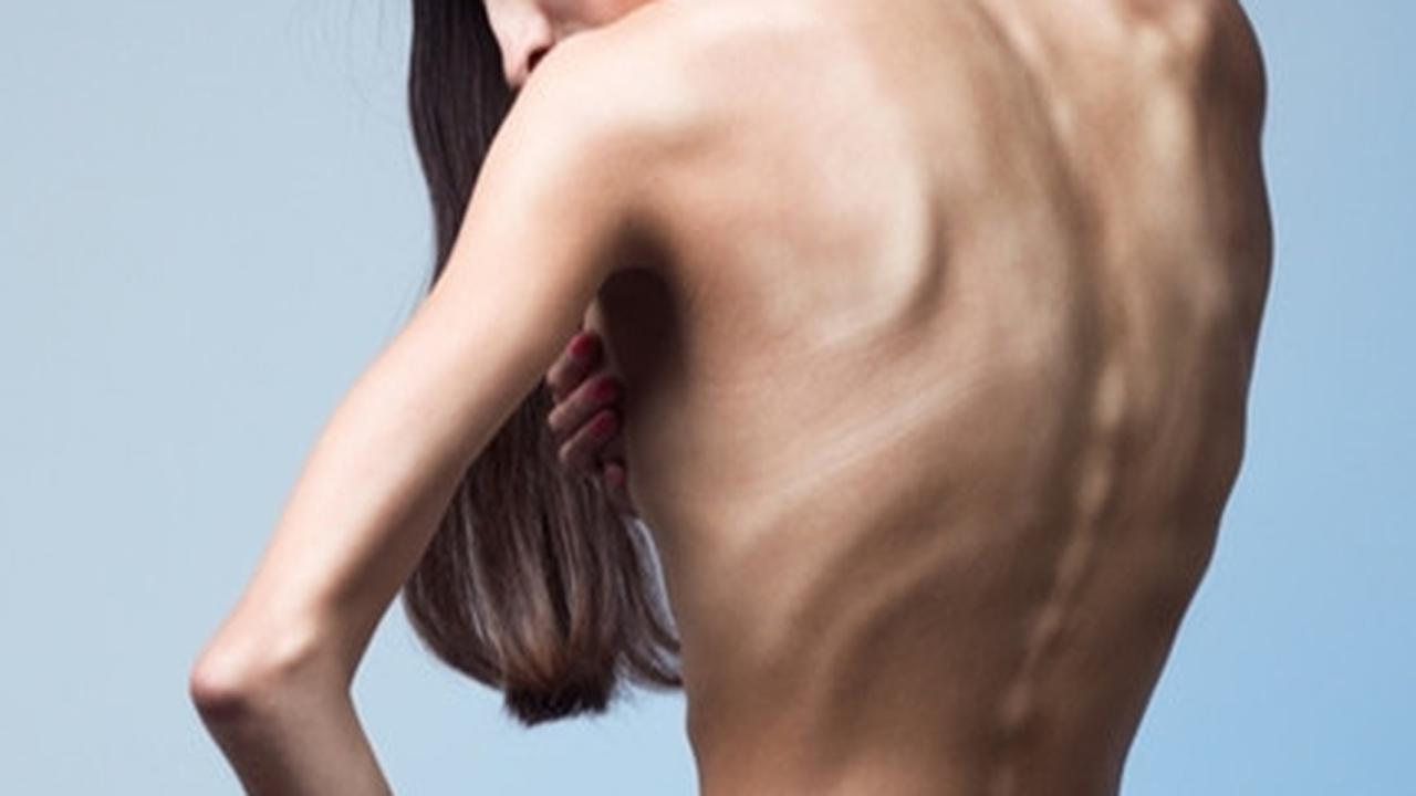 Anoreksia Nervosa, Dampak Buruk Gambar Tubuh atau Body Image Negatif (IV)