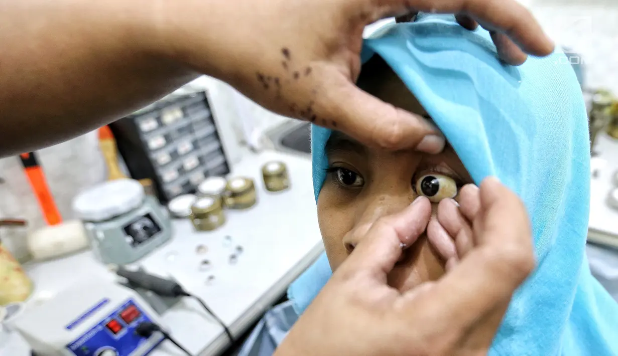 Sebuah bola mata palsu dipasang di mata kiri pasien Nurul di Klinik Ilyarsi Okularis, Ciputat, Tangerang Selatan, Banten, Sabtu (3/2). John Pacey-Lowrie mengajari Ilyasin selamat dua minggu. (Liputan6.com/Fery Pradolo)