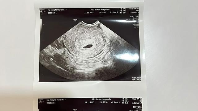 Setahun Melahirkan, Ini 6 Potret Syifa Adik Ayu Ting Ting Hamil Anak Kedua