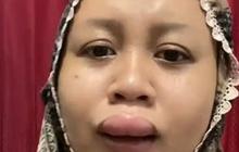Nasib Apes Jelang Pernikahan, Bibir Wanita Ini Tiba-tiba Jeding