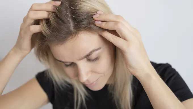 Gak Perlu Sampo Mahal, Ini 5 Cara Hilangkan Ketombe Secara Alami - Cover