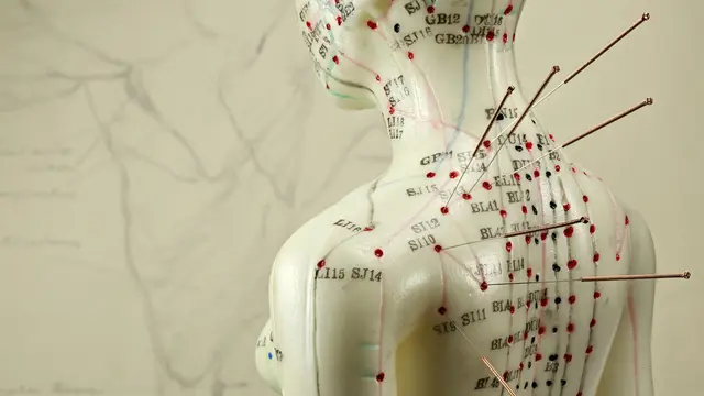 Berumur Ribuan Tahun, Akupunktur Kini Jadi Alternatif Pengobatan Alami dan Efektif