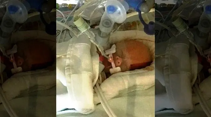 Bayi prematur bernama Lynn tak bisa bertahan hidup, ia pun meninggal, menyusul kematian sang ibu. (Foto: AP)