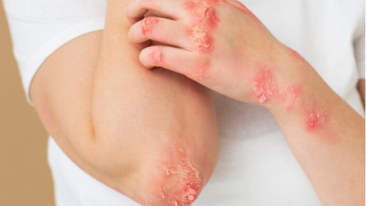 psoriasis