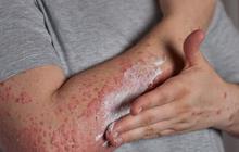 Apa Itu Lupus? Dari Jenis-jenis Hingga Pengobatan yang Harus Anda Ketahui!