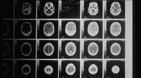 Ilustrasi X-Ray bayi tanpa tulang, satu-satunya di dunia (unsplash)