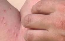 Kemenkes Ungkap Penyebab Kasus Cacar Monyet Meningkat