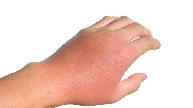 Ilustrasi Peradangan (Sumber: alodokter.com)