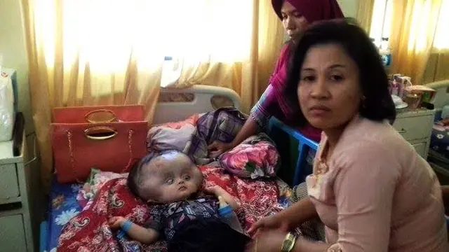 Bayi hidrosefalus