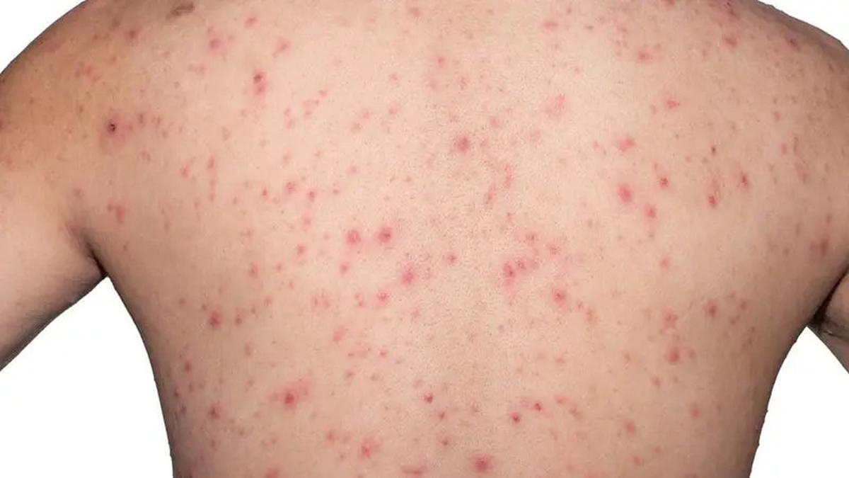 Ruam Panas (Heat Rash)
