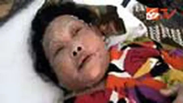 Marsiti Idap Penyakit Kulit Langka
