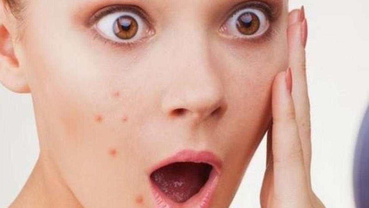 Jerawat Kamu Membandel? Tuntaskan dengan 3 Bahan Alami Ini