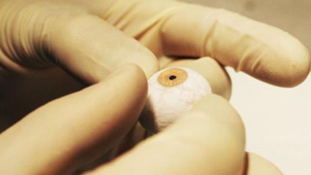Dua Kali Perawat Ini Salah Pasang Mata Palsu Health Liputan6 Com