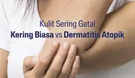 Tips Memilih Pelembab yang Tepat untuk Kulit Eksim, Jaga Skin Barrier