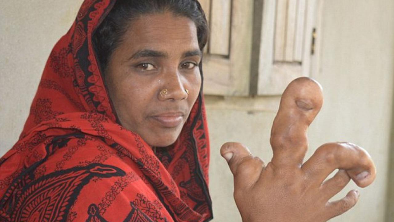 Didera Penyakit Aneh, Tangan Wanita Ini Membengkak Seperti Ubi