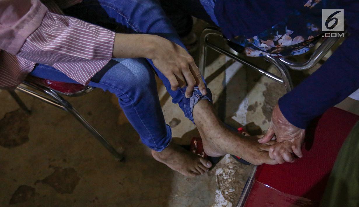 Warga sedang diperiksa kulit bagian kaki di komplek Rusunawa Muara Baru, Jakarta, Selasa (14/5/2019). Pemeriksaan kulit secara cuma-cuma merupakan program Vaseline Healing Project yang bertujuan meningkatkan perilaku hidup bersih dan sehat. (Liputan6.com/Fery Pradolo)