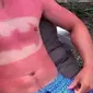 Para onliner rela terkena kanker kulit demi mengikuti tren Sunburn Art di sosial media.