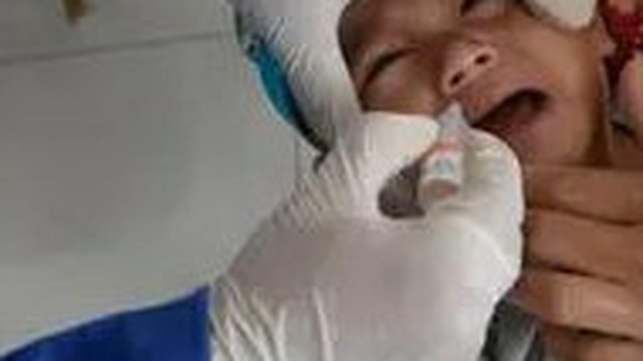 Dokter Ungkap Penyebab Anak Rentan Kena Polio