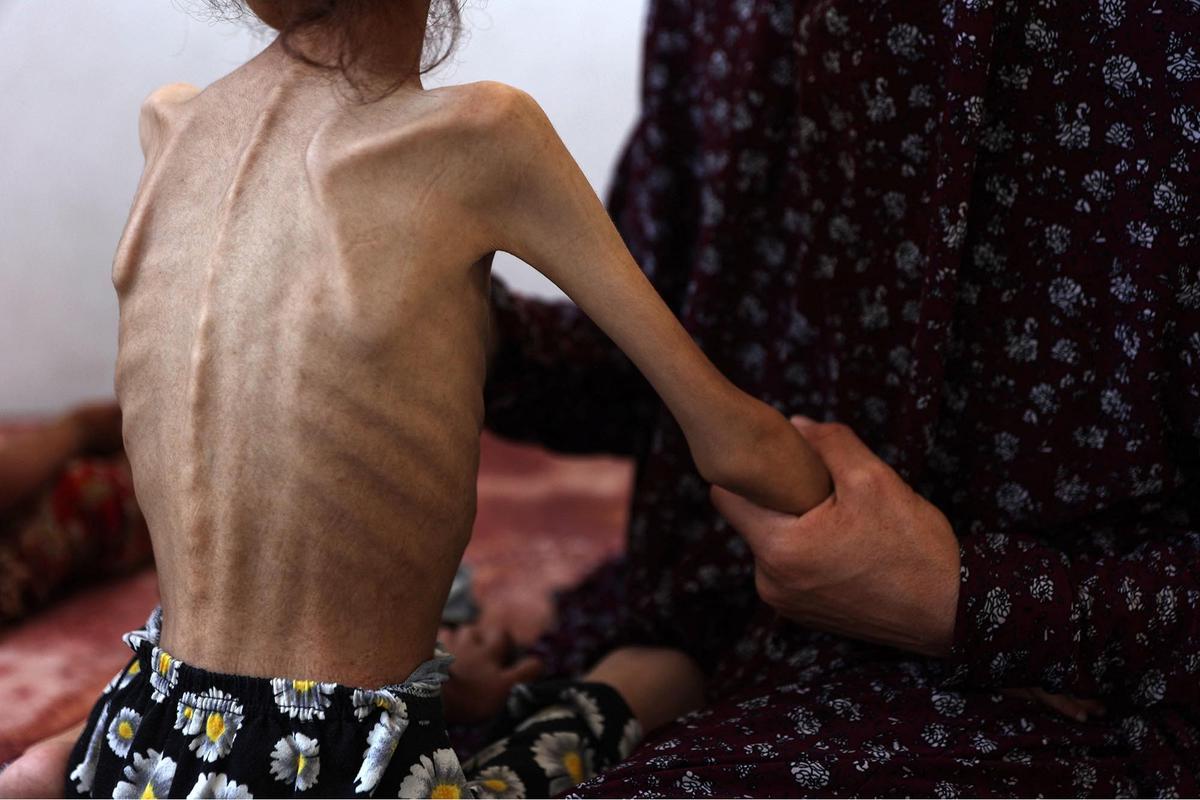 FOTO: Potret Pedih Mariam Anak 9 Tahun, Korban Kelaparan Gaza