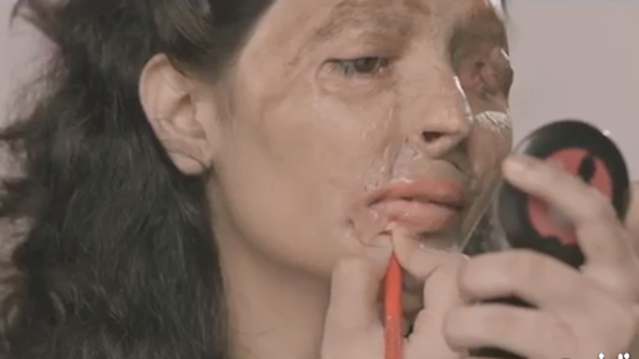 Kondisi Terkini Pemandu Lagu Cantik Korban Siraman Air Keras