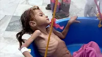 Seorang gadis yang menderita gizi buruk ditimbang di Pusat Kesehatan Aslam di Hajjah, Yaman, 25 Agustus 2018. Kelaparan diperparah dengan meningkatnya harga kebutuhan pokok dan turunnya nilai mata uang Yaman akibat konflik. (AP Photo/Hammadi Issa)