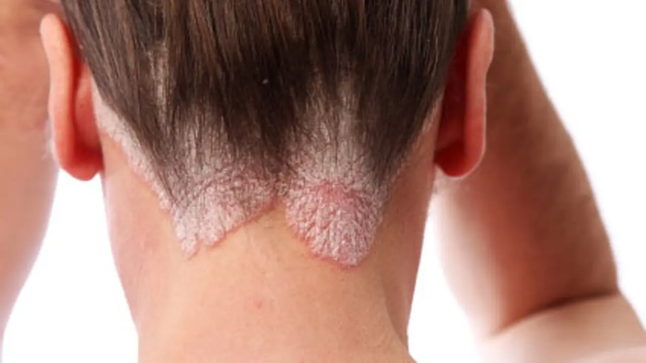 psoriasis