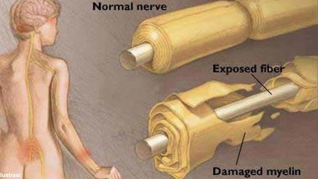 Guillain Barre Syndrome Dari Kesemutan Lalu Lumpuh Tak Berdaya Health Liputan6 Com