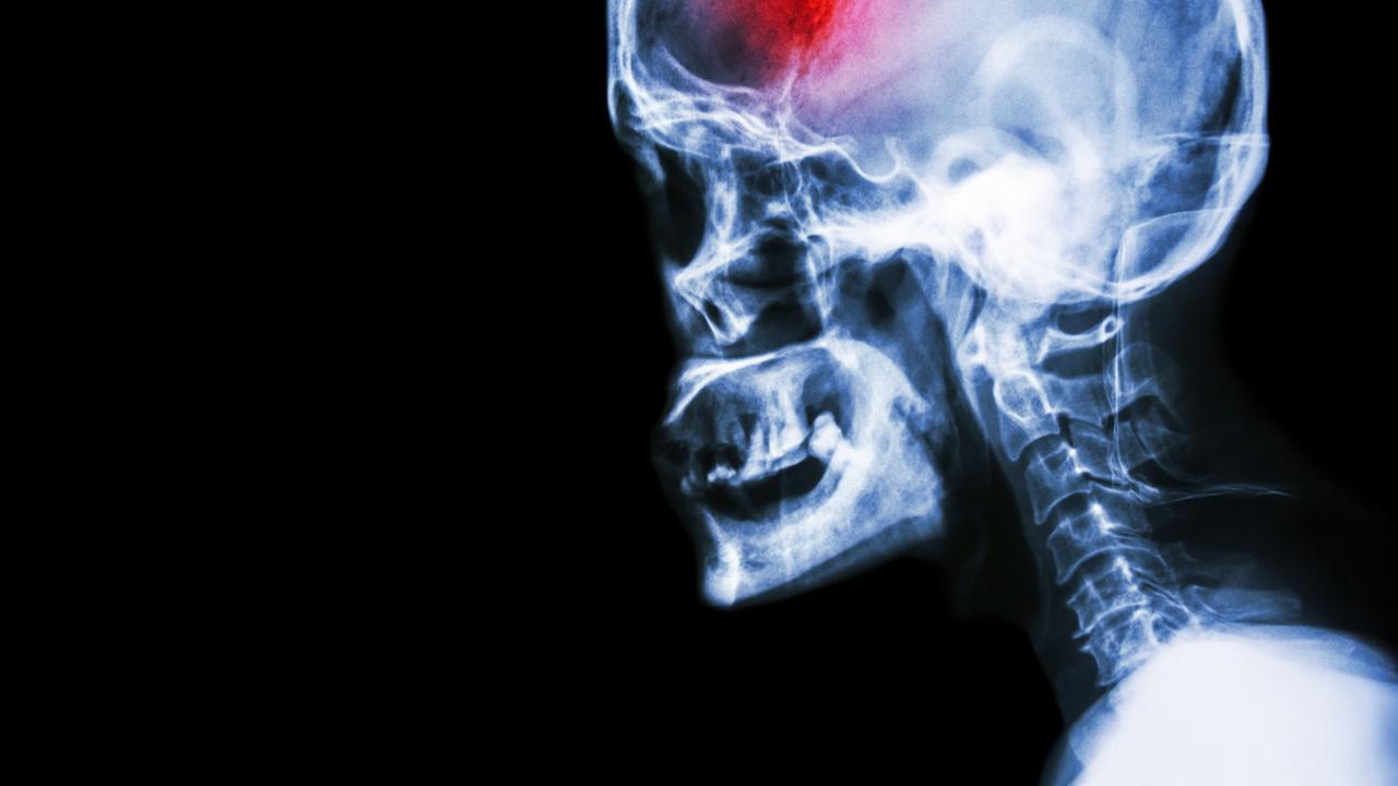 Ilustrasi stroke (iStockphoto)