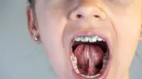 Tongue Tie adalah Gangguan Tali Lidah yang Bisa Picu Masalah pada Anak, Simak Penangannya!