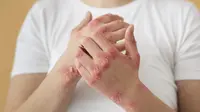 Ilustrasi penyakit psoriasis. (Credit: Freepik)