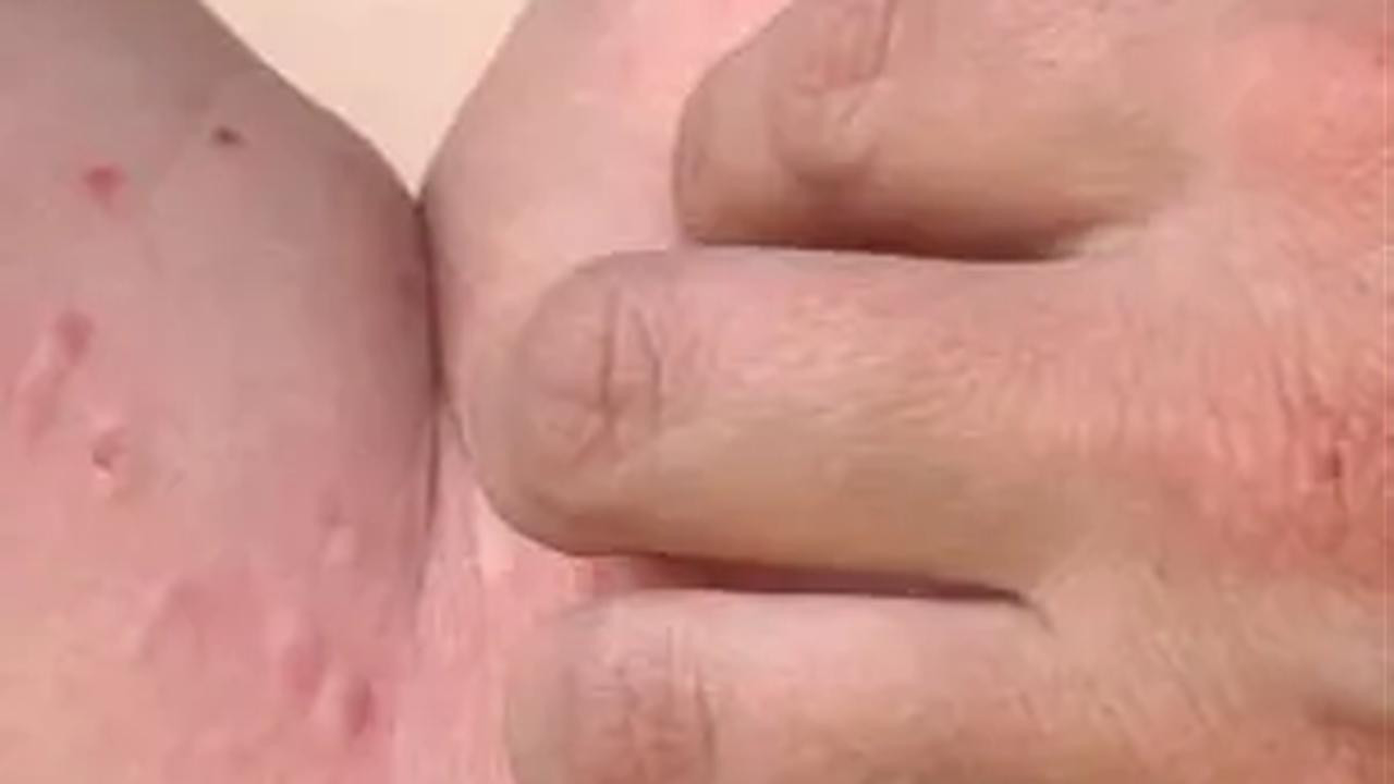 Kemenkes Ungkap Penyebab Kasus Cacar Monyet Meningkat