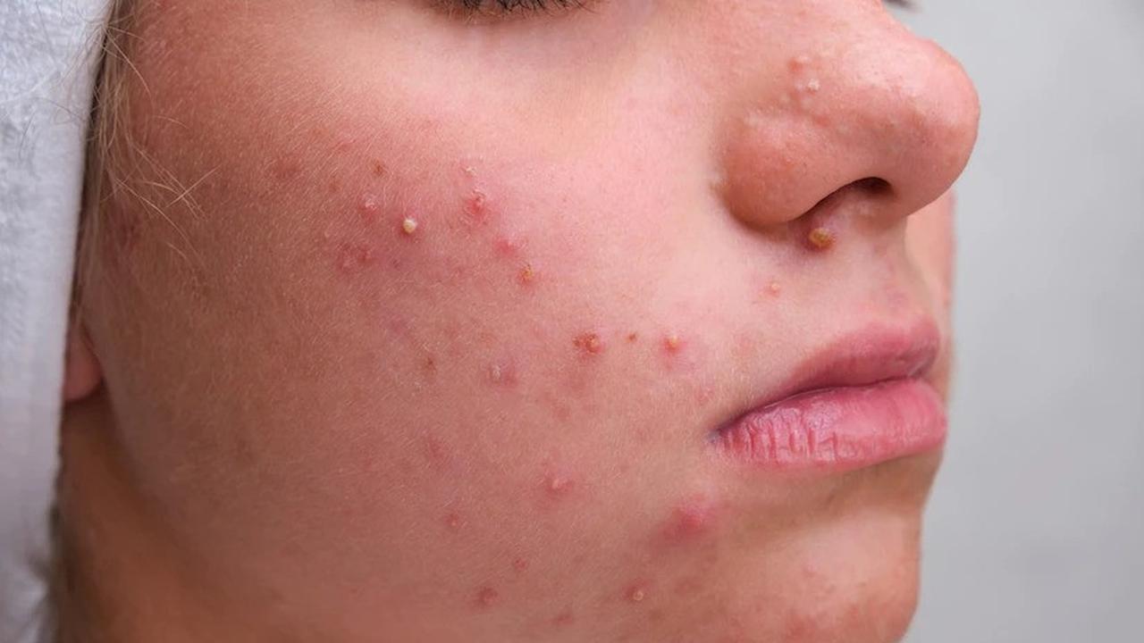 ilustrasi kista jerawat. sumber: freepik
