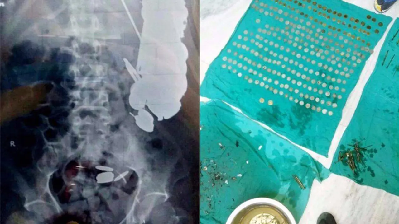 Dokter Temukan 263 Koin dan 100 Paku di Perut Pria Ini, Santet?