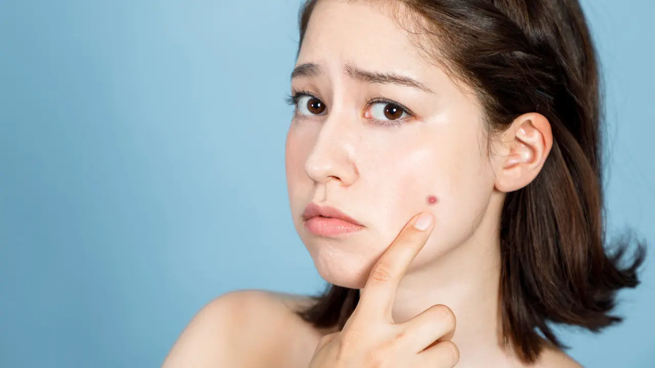 Jerawat Bisa Picu Depresi, Ini Faktanya (chombosan/shutterstock)