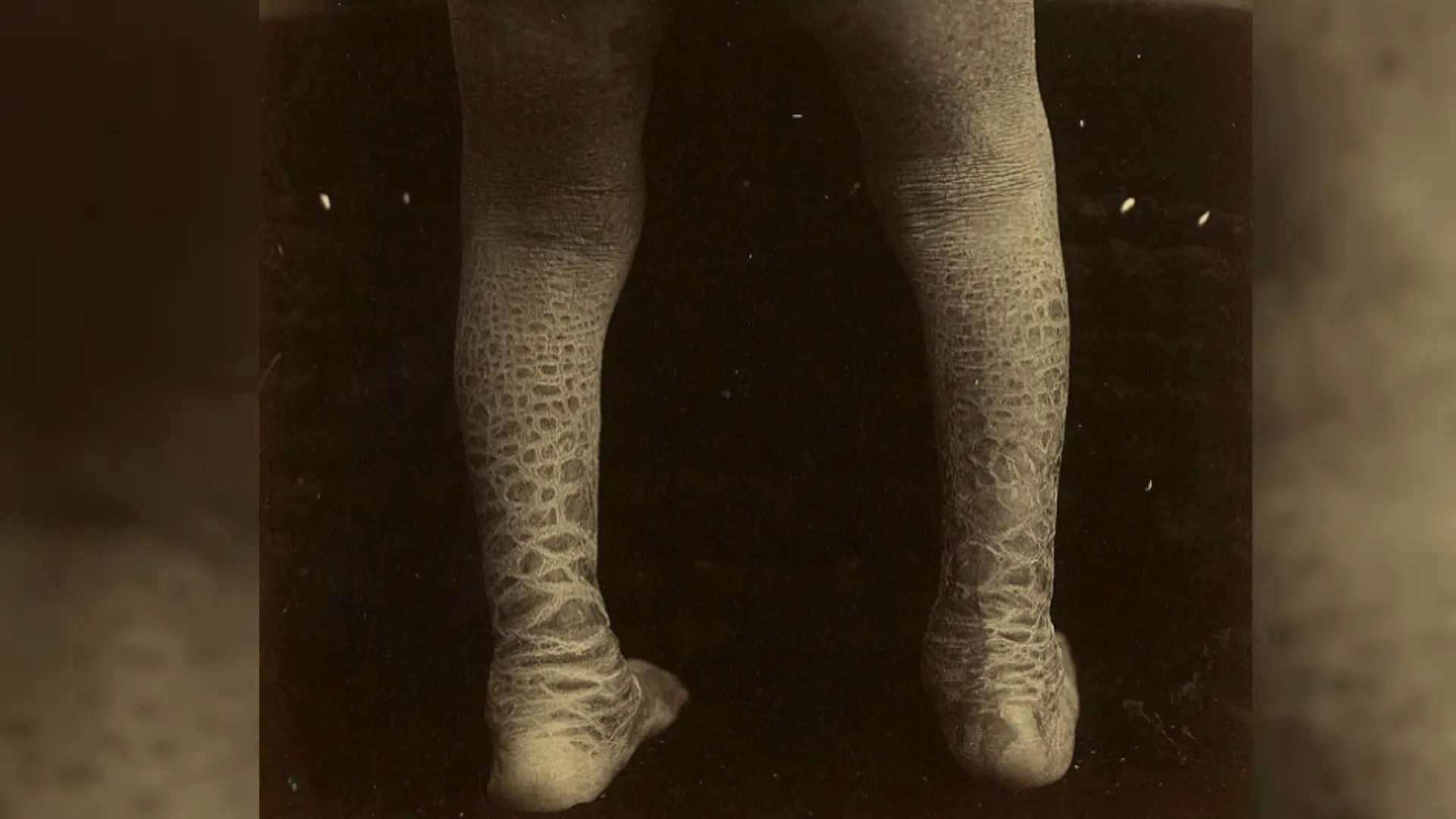 Harlequin Ichthyosis. (Sumber Flickr/National Museum of Health)