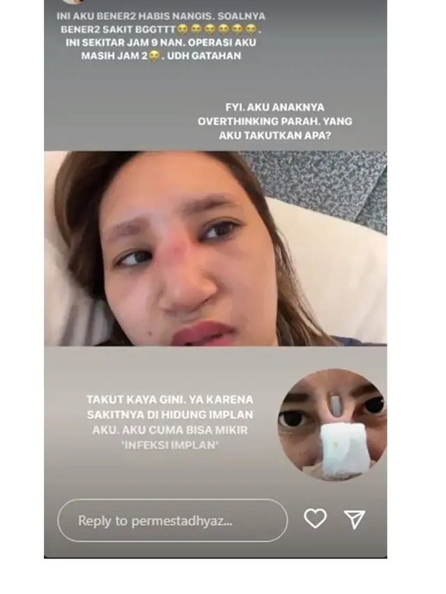 12 Foto Kronologi Dhyaz Anak Farida Nurhan Alami Infeksi Hidung hingga Angkat Implan