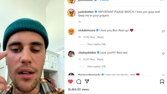 Justin Bieber alami Ramsay Hunt Syndrome yang membuat wajah lumpuh sebelah. (Foto: Potongan layar Instagram @justinbieber)