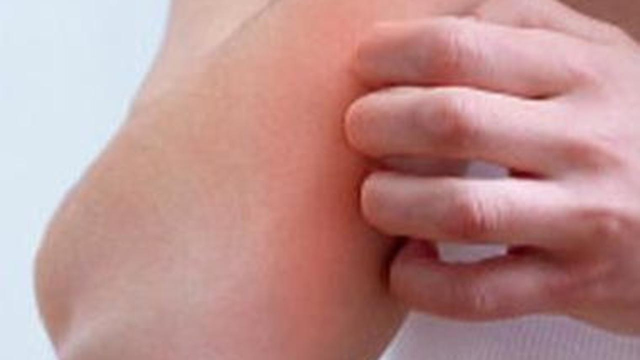 Gejala Psoriasis Vulgaris, Gangguan Autoimun Lesi Merah dan Bercak pada Kulit