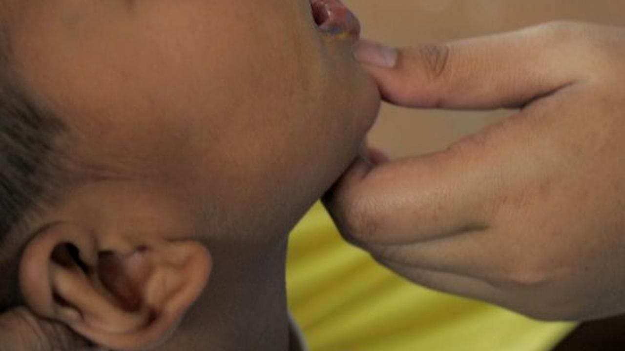 Cara Mencegah Polio yang Wajib Diketahui, Kenali Gejalanya