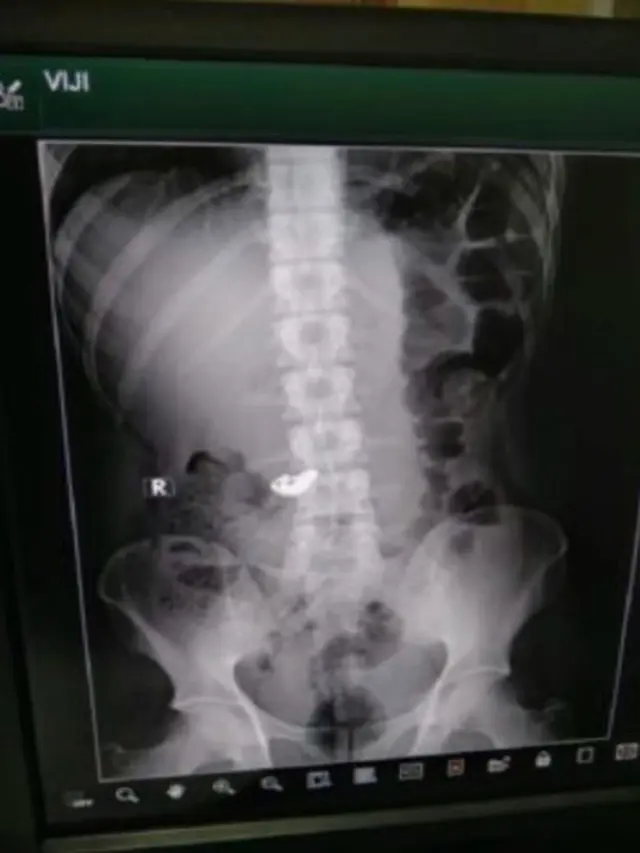 Demi Keluarkan Kalung Emas yang Ditelan, Pencuri Dipaksa Makan Pisang