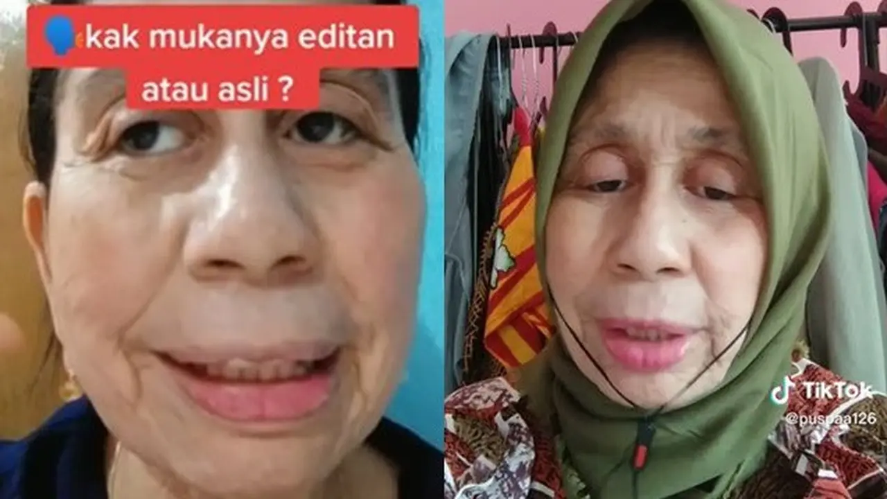 Sering Disangka Nenek-nenek, Wanita 28 Tahun Ini Idap Penyakit Langka