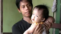 Bayi Penderita Tumor Meningokel Ini Butuh Bantuan
