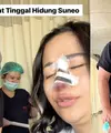 Tak mau disebut hidung Suneo, Farida Nurhan memutuskan operasi plastik di hidungnya. Perempuan kelahiran Lumajang 41 tahun silam itu mempercayakan ke dr Tompi. [Instagram/farida.nurhan]