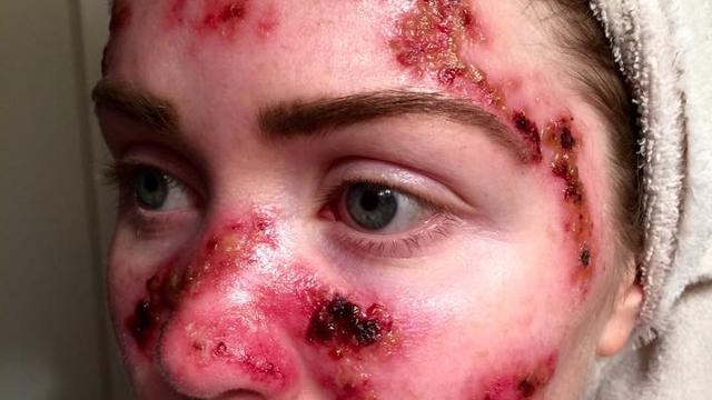 Wanita ini Berani Selfie Untuk Tingkatkan Kesadaran Kanker Kulit