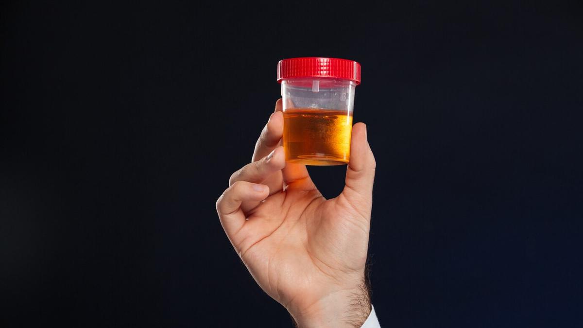 Ciri-Ciri Penyakit Asam Urat yang Terlihat pada Urine, Lakukan Deteksi Dini Sebelum Terlambat